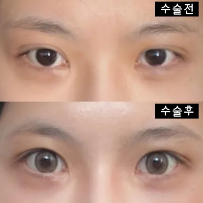 위버스성형외과에서 수술한지 두달째 되는 날이에요~