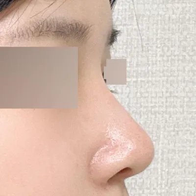 위버스성형외과에서 수술한지 두달째 되는 날이에요~