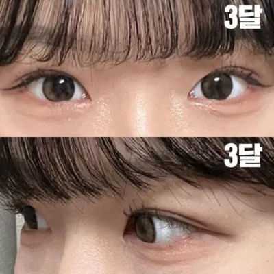 심정환 원장님께 인아웃라인으로 수술 했어요.