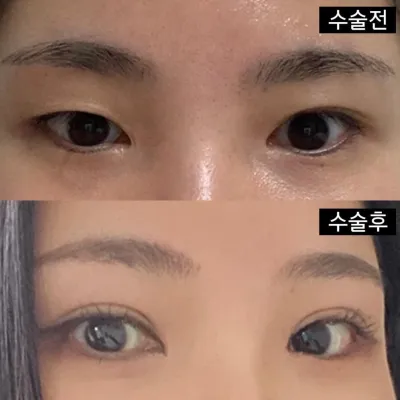 쌍수, 눈재수술이시면 꼭 방문 추천합니다