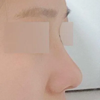 콧대 생기니깐 옆모습도 이뻐지고 입체감도 생겼어요!