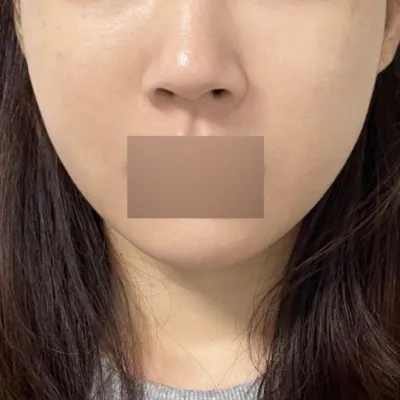 위버스성형외과에서 실리프팅 1일차 됐어용