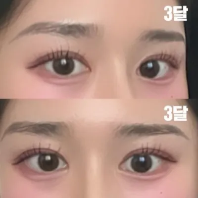 쌍커풀 수술을 한 지 3달 차 입니다.