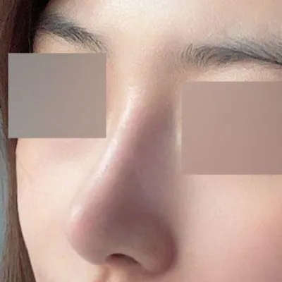 코재수술하고 별일없이 3개월 경과까지 왔네요 ㅎㅎ