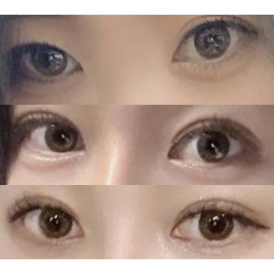 눈재수술 자연스럽게 성공했어요!