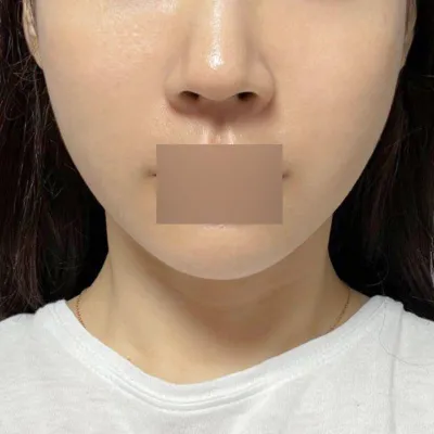 실리프팅 2주차인데 효과는 정말 확실하네용!