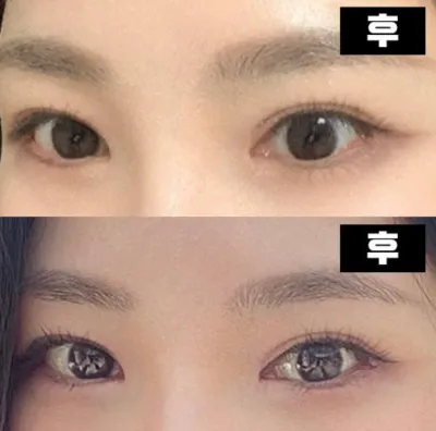 쌍꺼풀 수술로 고민하고 계시다면 정말 강추 합니다~