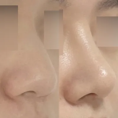 복코 무보형물 수술 받았습니다