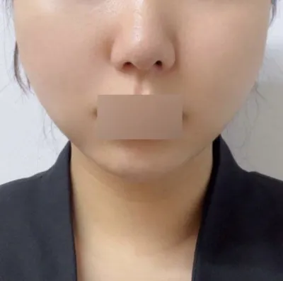 실리프팅으로 받은게 신의 한수였어요