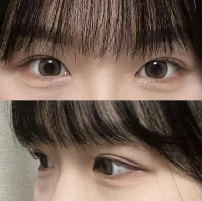 꼼꼼히 상담해주셔서 위버스성형외과에서 하게 되었습니다!