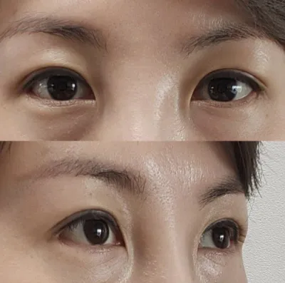 생각하면 너무 설레요! 수술받길 잘한 것 같아요