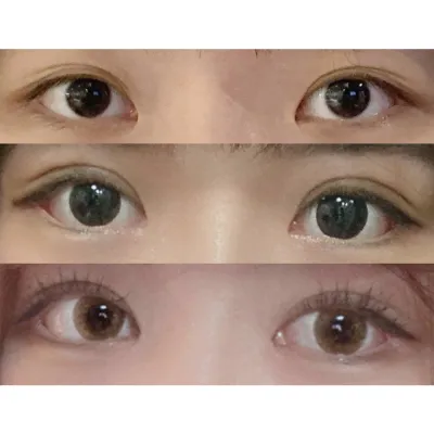 뒷밑트임+자연유착+눈매교정 후기!