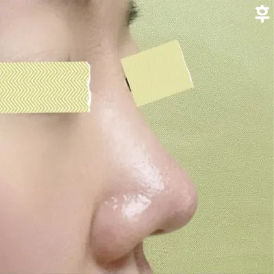 코수술한거 진짜 인생에서 잘한 선택이라고 생각하는중입니다!