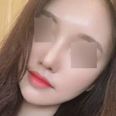 위버스에서 코수술한지 세 달 됐어요!