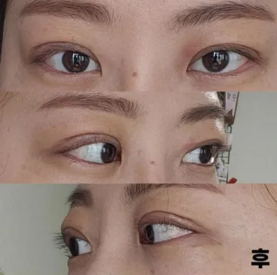 수술하길 정말 잘한것 같아요