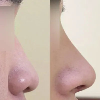 낮고 처진 코 수술 후기