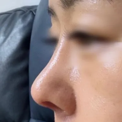 코끝이 뚝 떨어지는게 고민이였는데 코끝이 생겨서 너무 좋네요^^