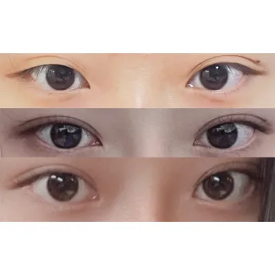 눈, 코 같이 수술 받았어요ㅎㅎ