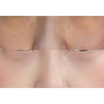 피곤해 보이는 눈밑지방 개선했어요ㅎ