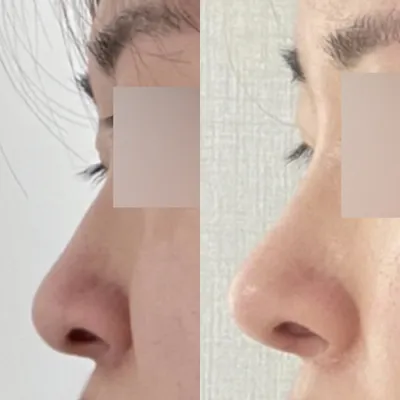 오랜 컴플렉스였던 코 드디어 수술했어요~