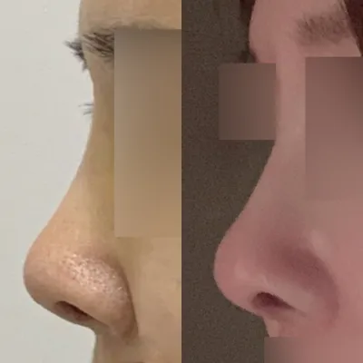 5년전에 불현듯 코수술을 했어요:-)))