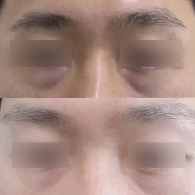 눈밑 지방 재배치 2달차 후기입니다 :)