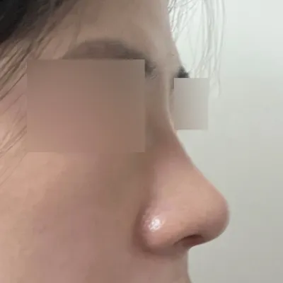 복코수술 받았습니다