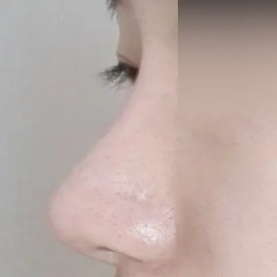 비염수술이랑 코수술 같이했어요!