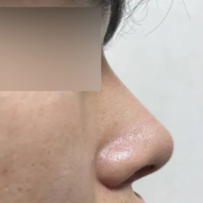 심원장님께 코수술한지 2달차입니다