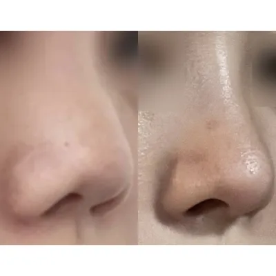 코 수술 받은지 이제 한달이 조금 넘었어요!