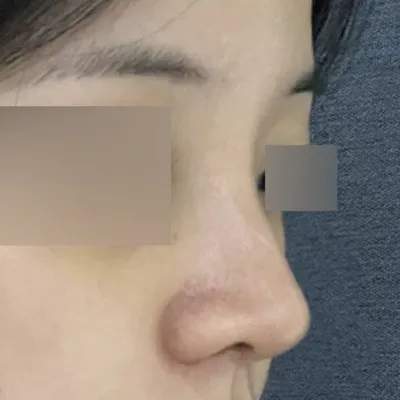 수술한지 2주차에요