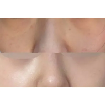 심정환 원장님께 눈밑지방재배치 수술 받았습니다!