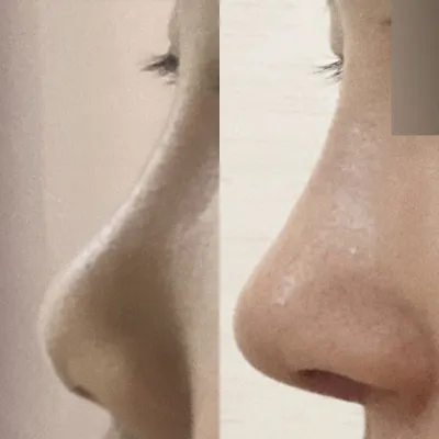 심정환 원장님께 수술 받은 지 2주차에요