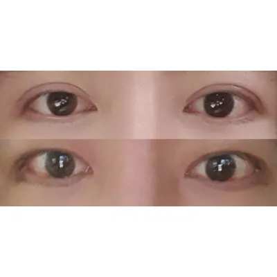 남자 두줄따기로 쌍꺼풀 축소 재수술 + 눈매교정 10일 후