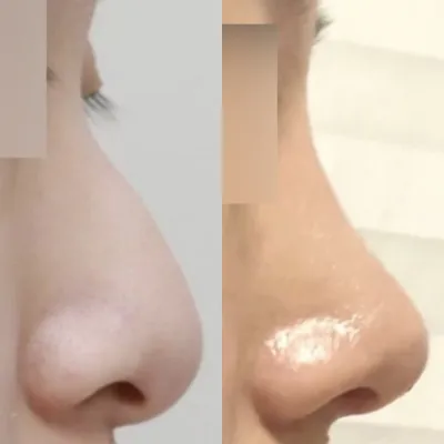 첫 코수술 무보형물로 받았어요!