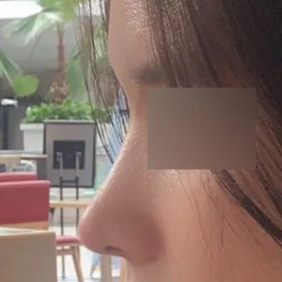 밋밋했던 매부리코 수술 받았어용