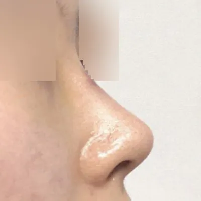 처진 코끝 수술 받았어요