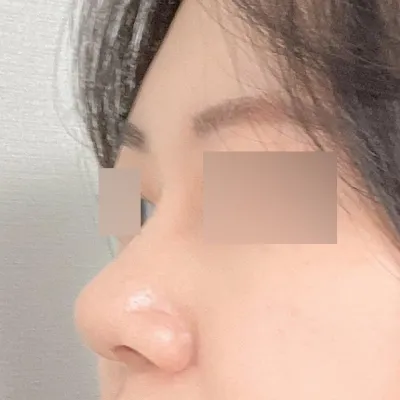 수술 3달차 후기