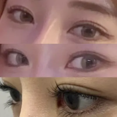 눈 수술한지 어느덧 1달이 지났어요~~