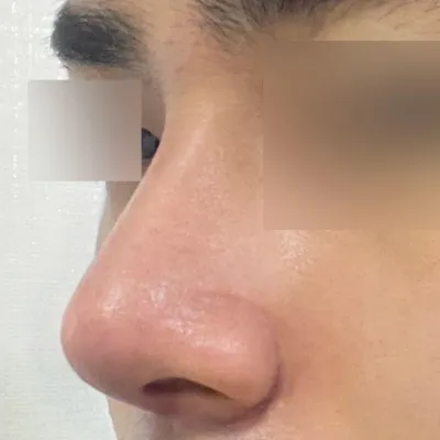 위버스 성형외과에서 수술 받은지 2주차입니다.