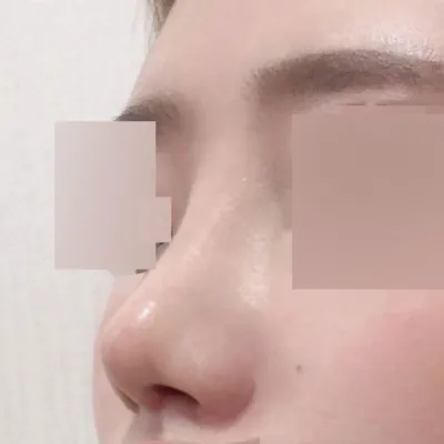 복코 재수술 받았어요!