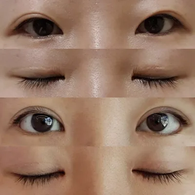 눈 수술 받은지 2달차입니다