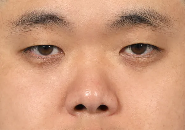 Before