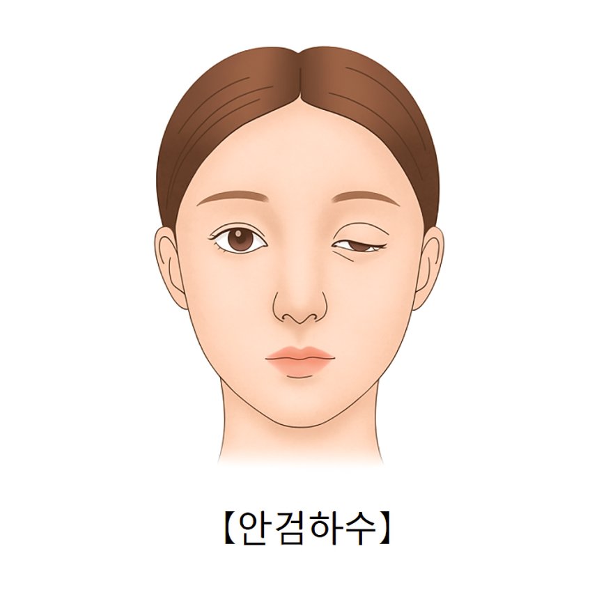 졸려보이는 눈, 안검하수일까? 원인과 자연유착 눈매교정 수술 정보