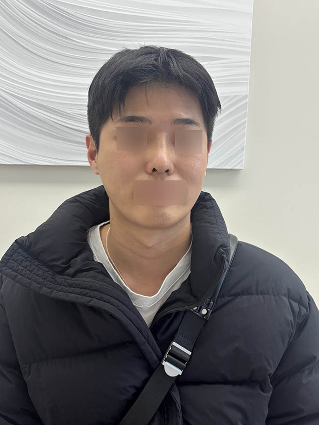 남자 코 재수술 리뷰!!