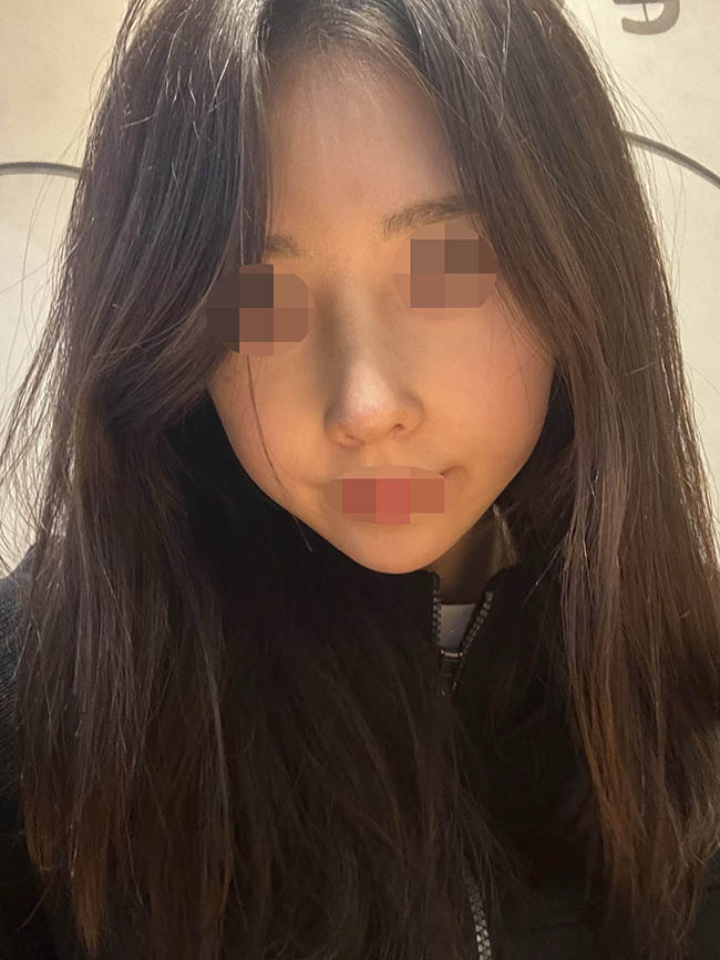 원트에서 자가늑 코수술 받았습니당!