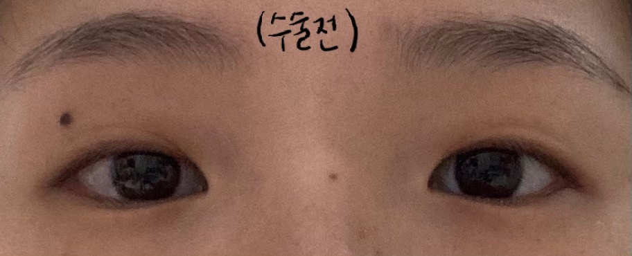 매몰+앞트임 후기