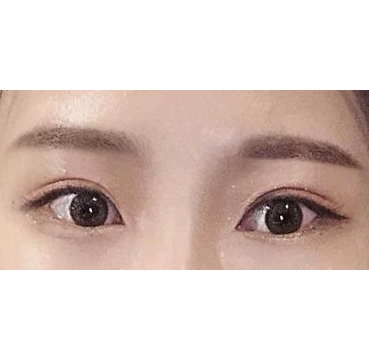 절개쌍꺼풀 눈매교정 한달째입니다.