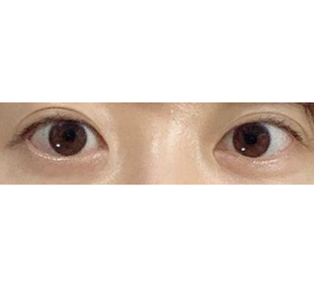 눈매교정 너무 자연스럽네요!