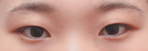 절개 쌍꺼풀 앞트임 수술 한달 차